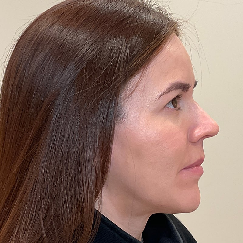 Sculptra Before & After Image