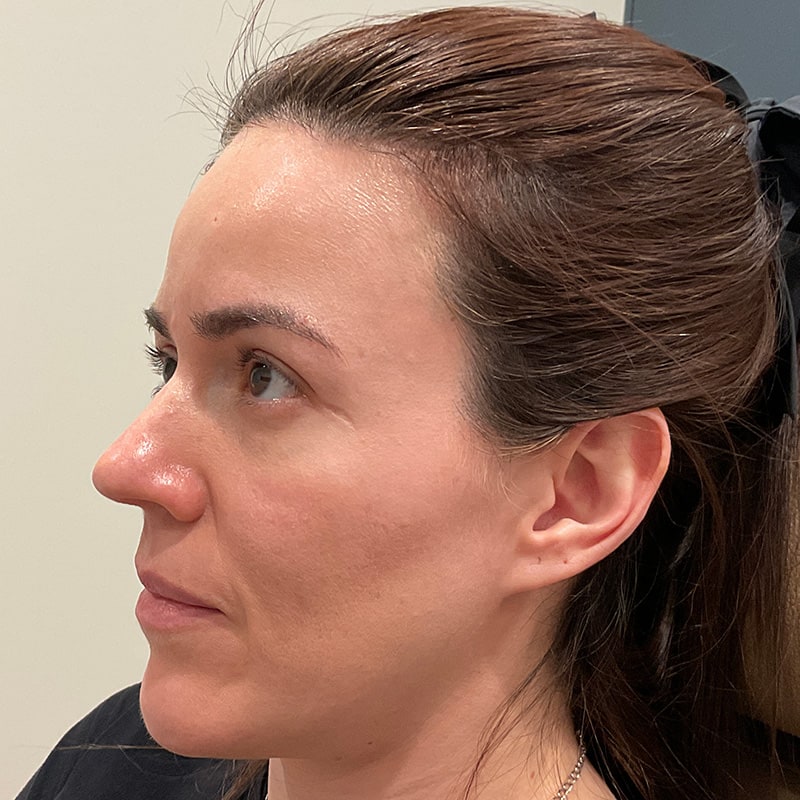 Sculptra Before & After Image