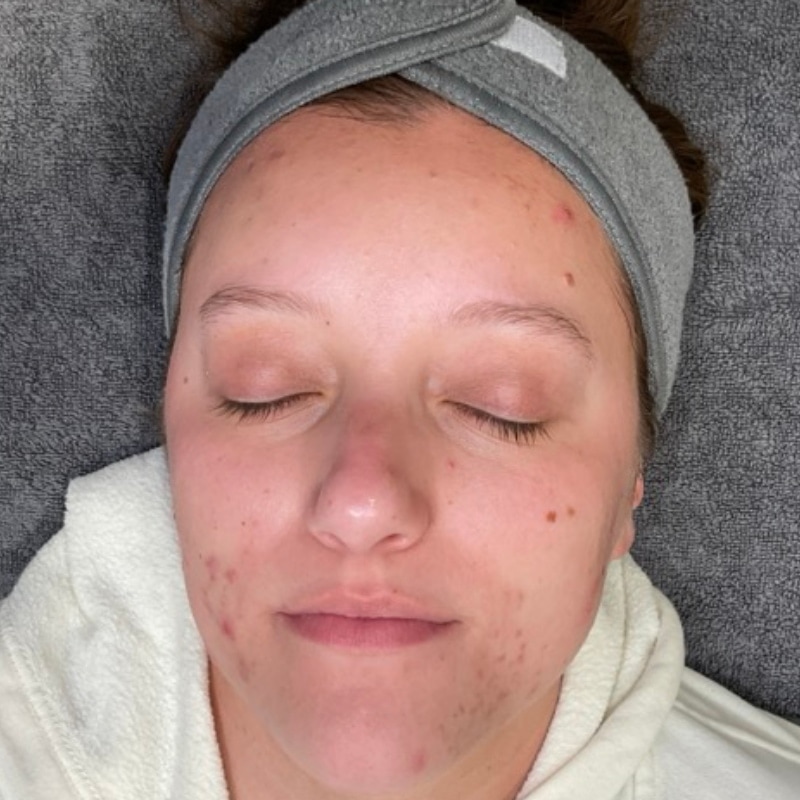 Acne Treatment Before & After Image