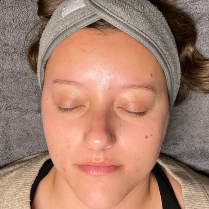 Acne Treatment Before & After Image