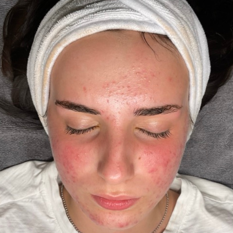 Acne Treatment Before & After Image