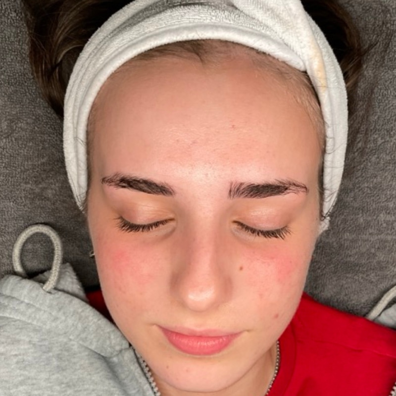 Acne Treatment Before & After Image