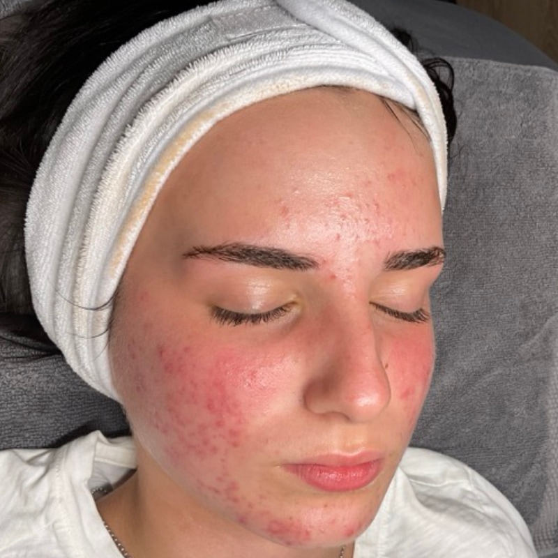 Acne Treatment Before & After Image