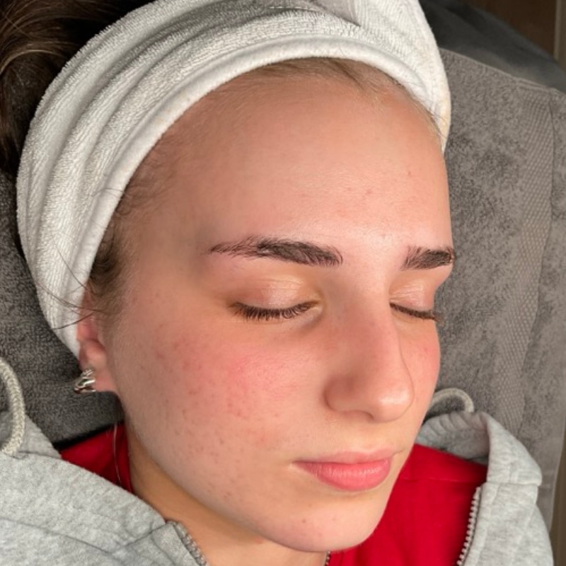 Acne Treatment Before & After Image