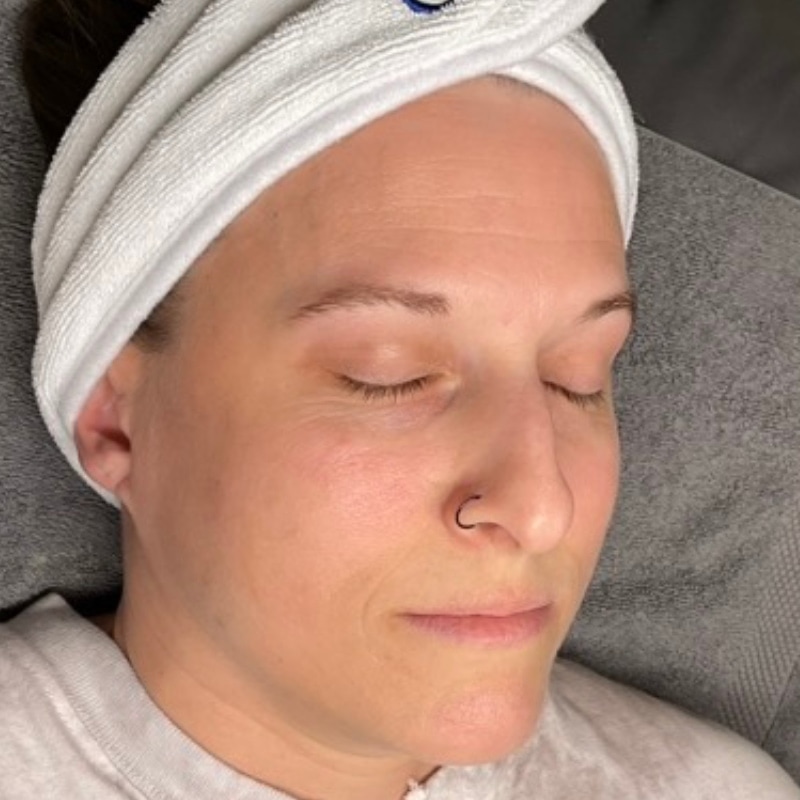 Chemical Peels Before & After Image