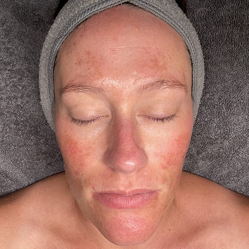 Facials Before & After Image
