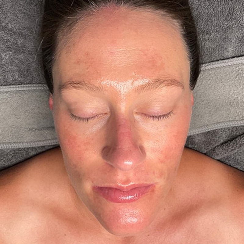 Facials Before & After Image