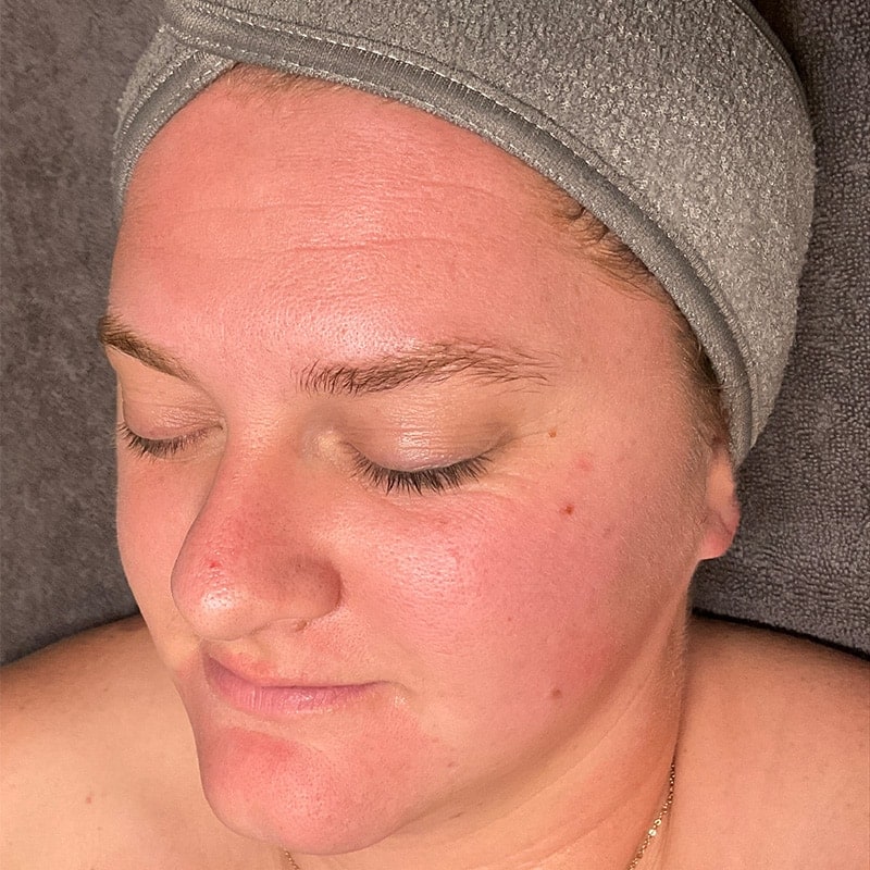 Facials Before & After Image