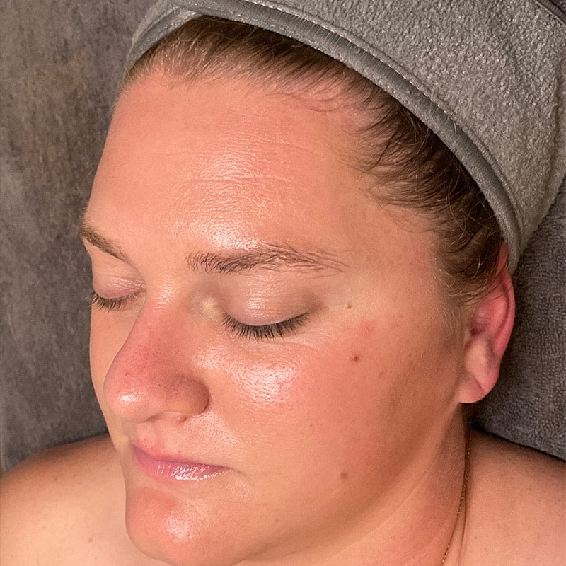 Facials Before & After Image