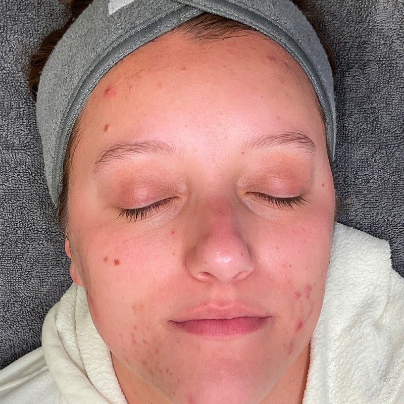 Facials Before & After Image