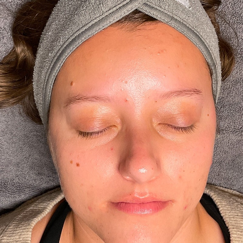 Facials Before & After Image