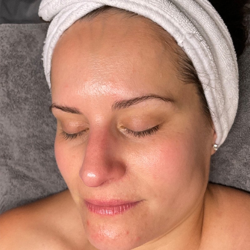 Facials Before & After Image