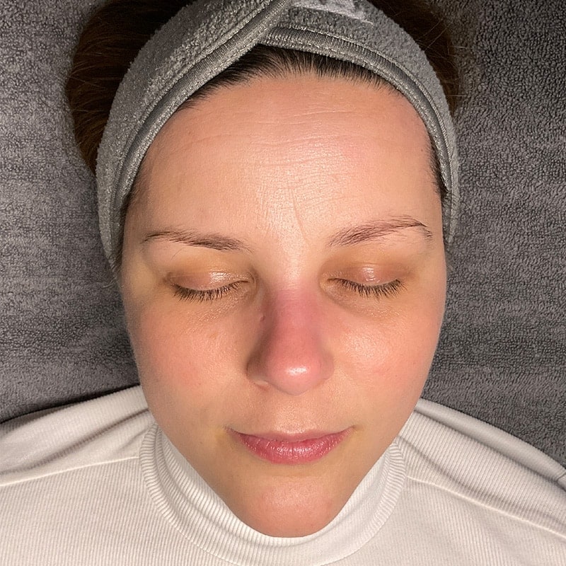 Facials Before & After Image