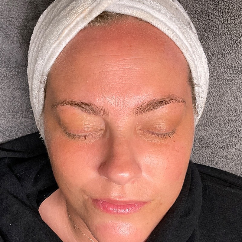 Facials Before & After Image