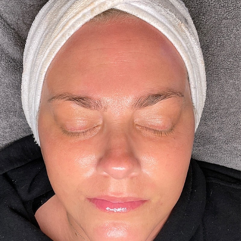 Facials Before & After Image