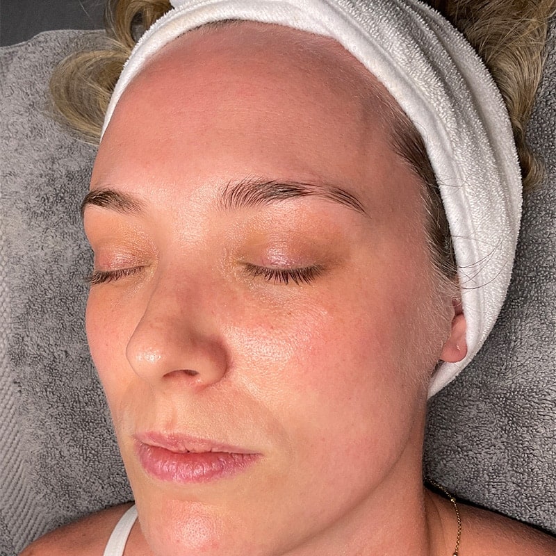 Facials Before & After Image