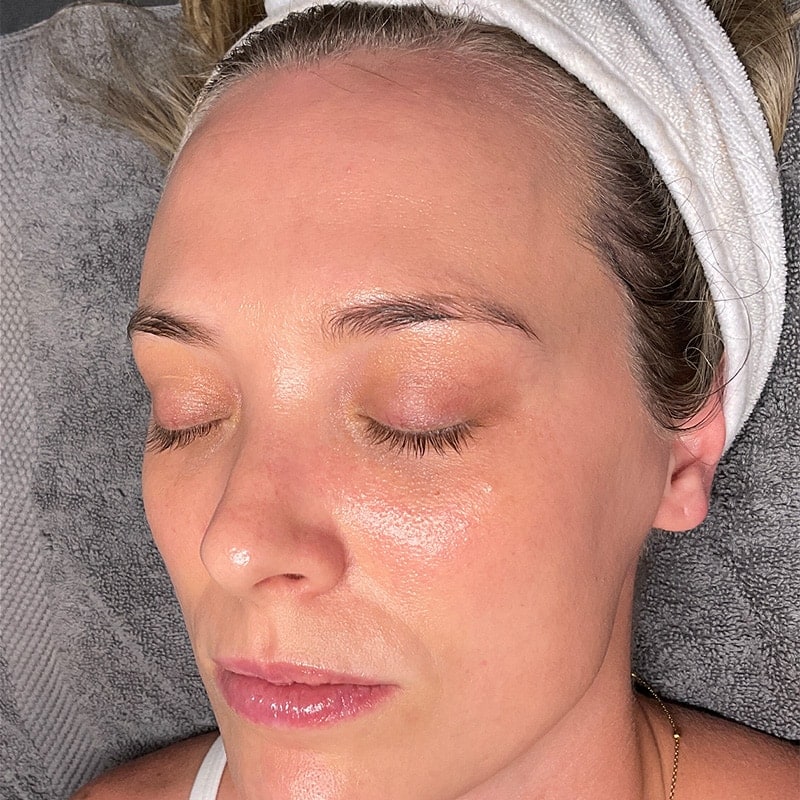 Facials Before & After Image