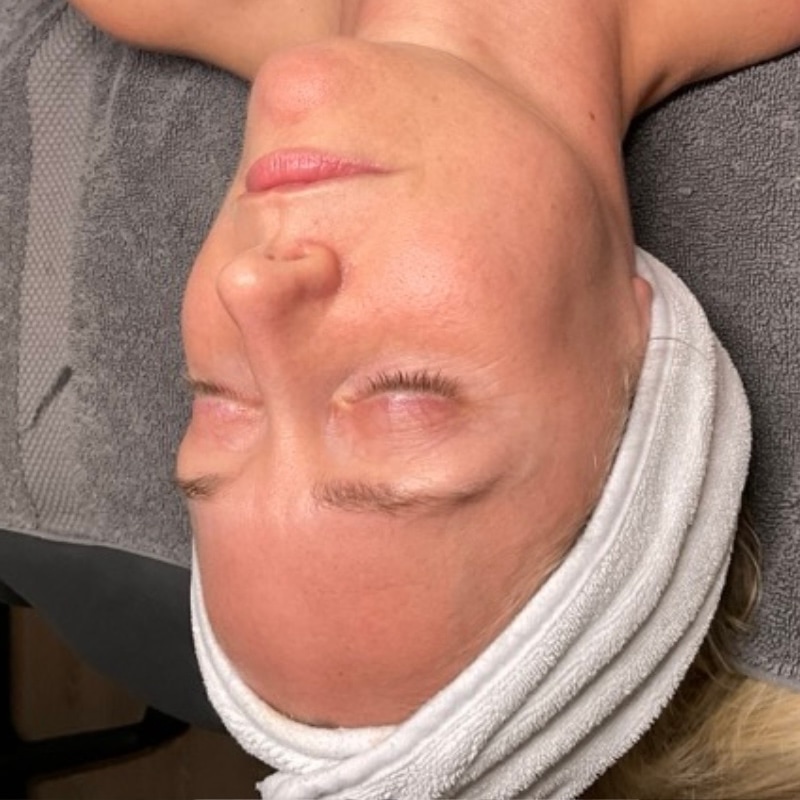 facials Before & After Image