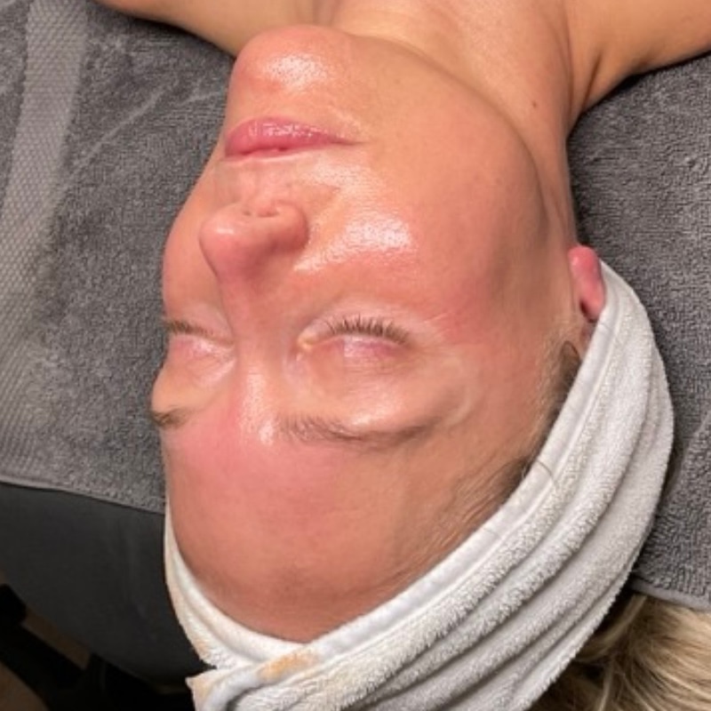 facials Before & After Image