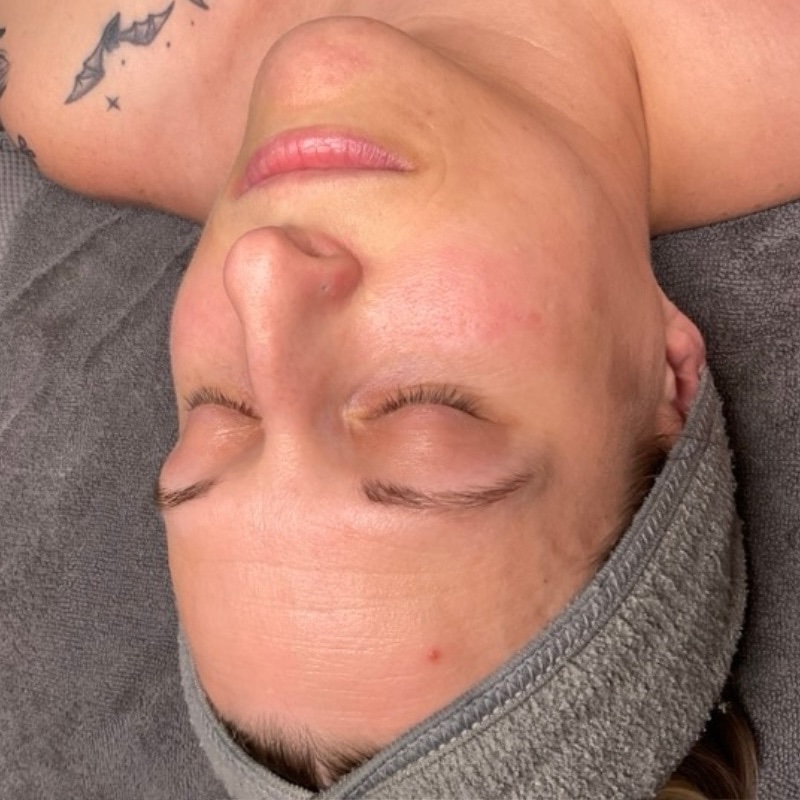 facials Before & After Image