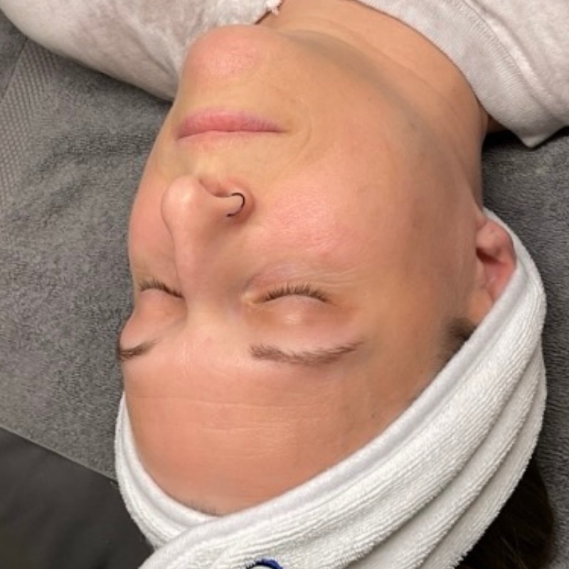 facials Before & After Image
