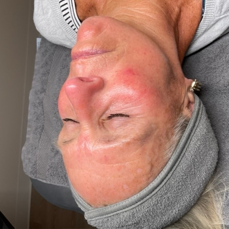 Facials Before & After Image