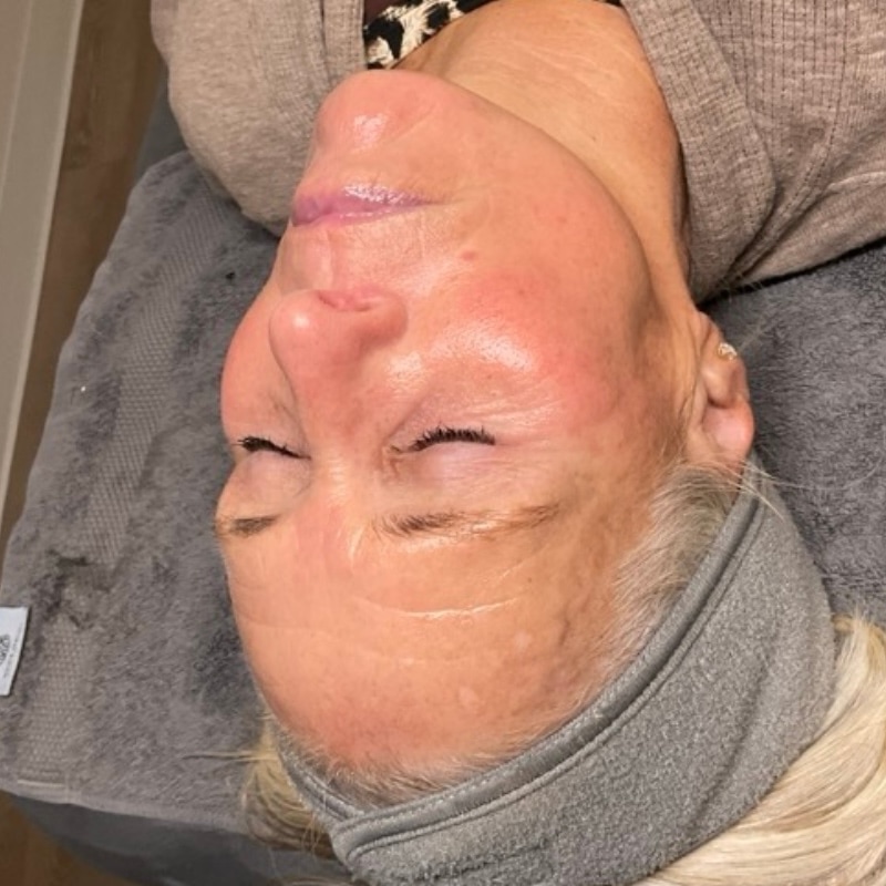 Facials Before & After Image