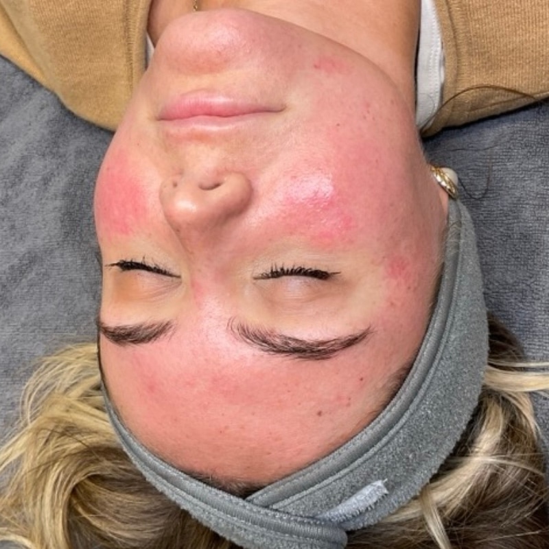 Facials Before & After Image