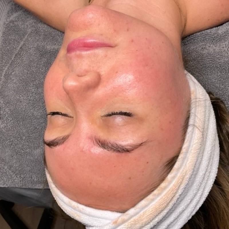 Facials Before & After Image