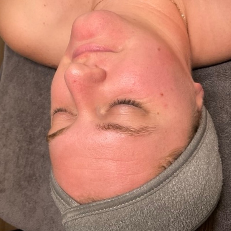 Facials Before & After Image