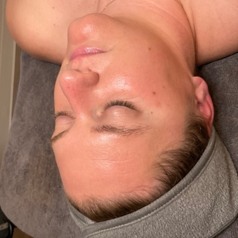 Facials Before & After Image