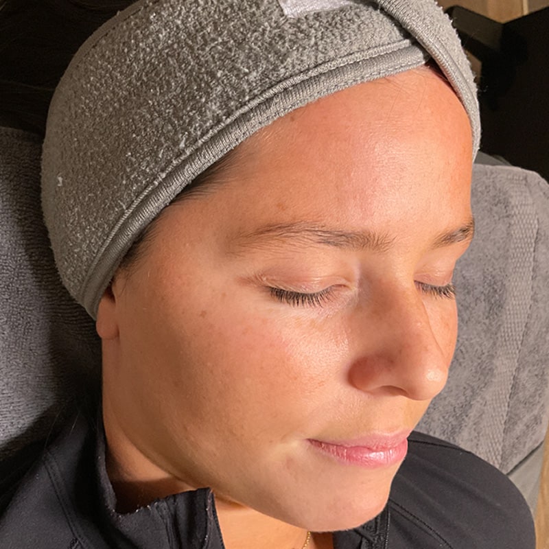 HydraFacials Before & After Image