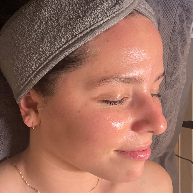 HydraFacials Before & After Image