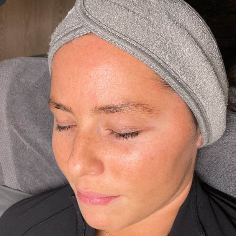 HydraFacials Before & After Image