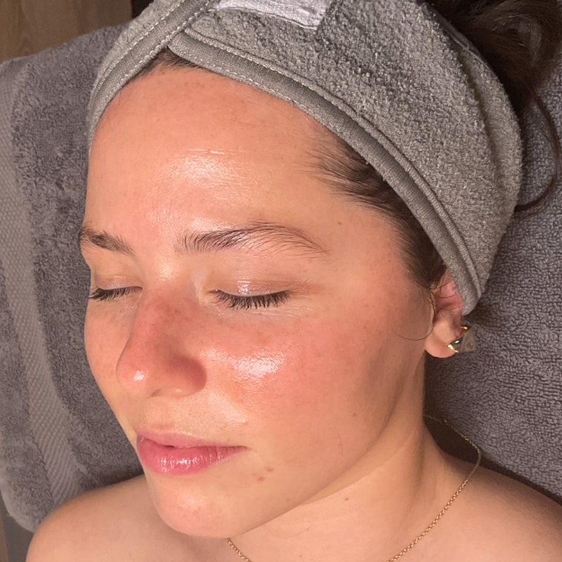 HydraFacials Before & After Image