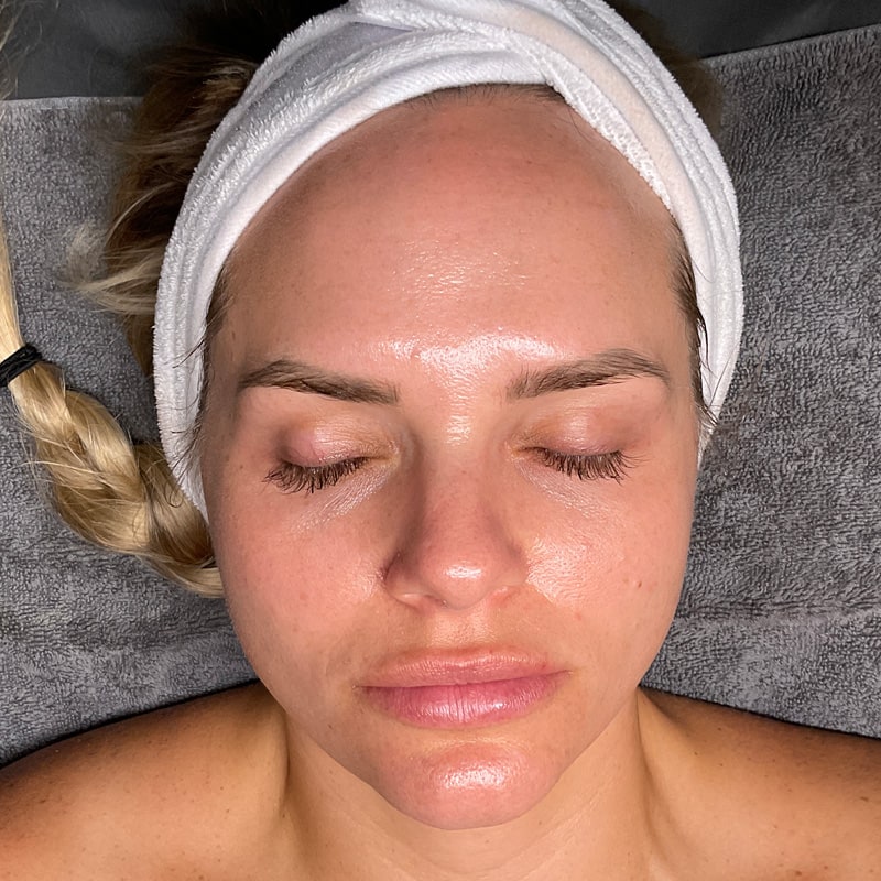 HydraFacials Before & After Image