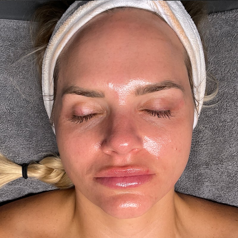 HydraFacials Before & After Image