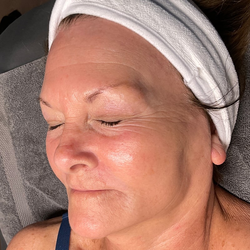 HydraFacials Before & After Image