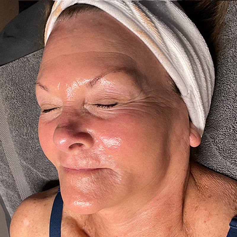 HydraFacials Before & After Image