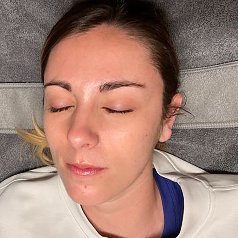 HydraFacials Before & After Image