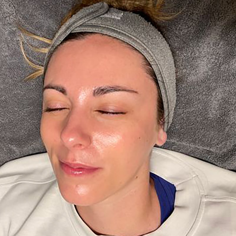 HydraFacials Before & After Image