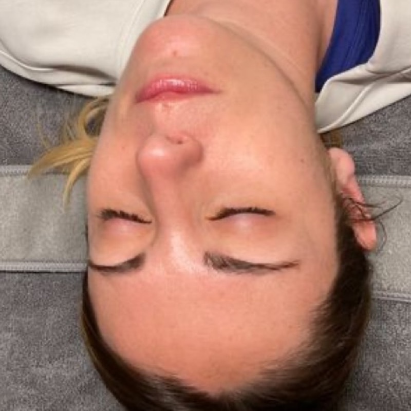 HydraFacials Before & After Image