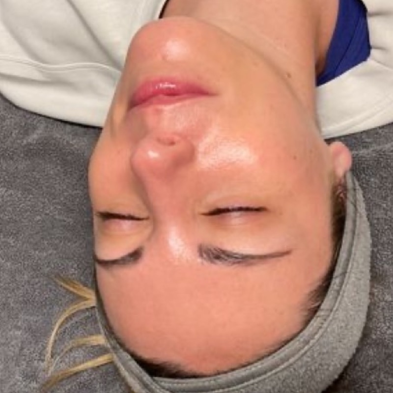 HydraFacials Before & After Image