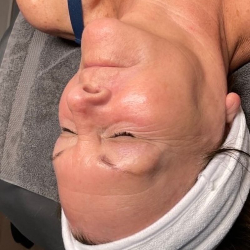 HydraFacials Before & After Image