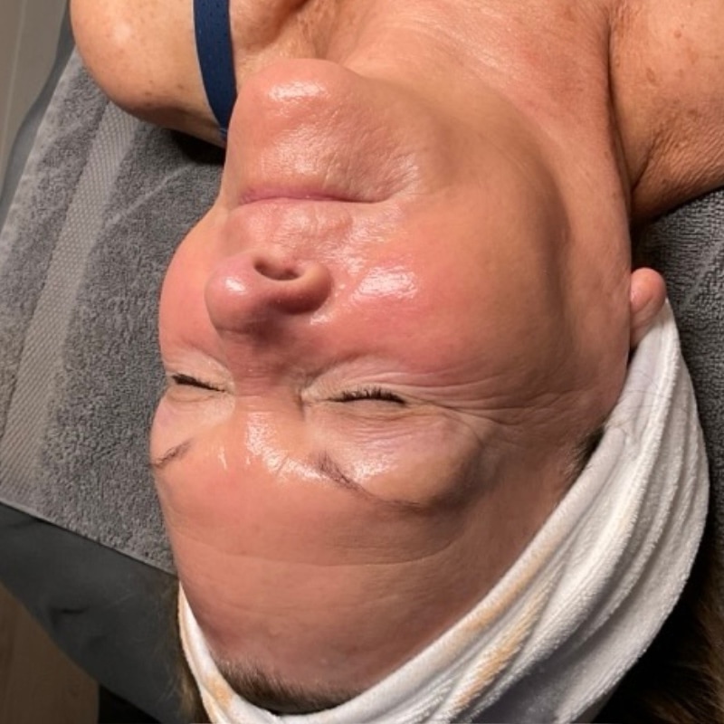HydraFacials Before & After Image