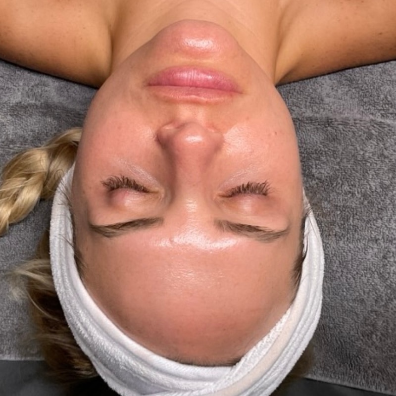 HydraFacials Before & After Image