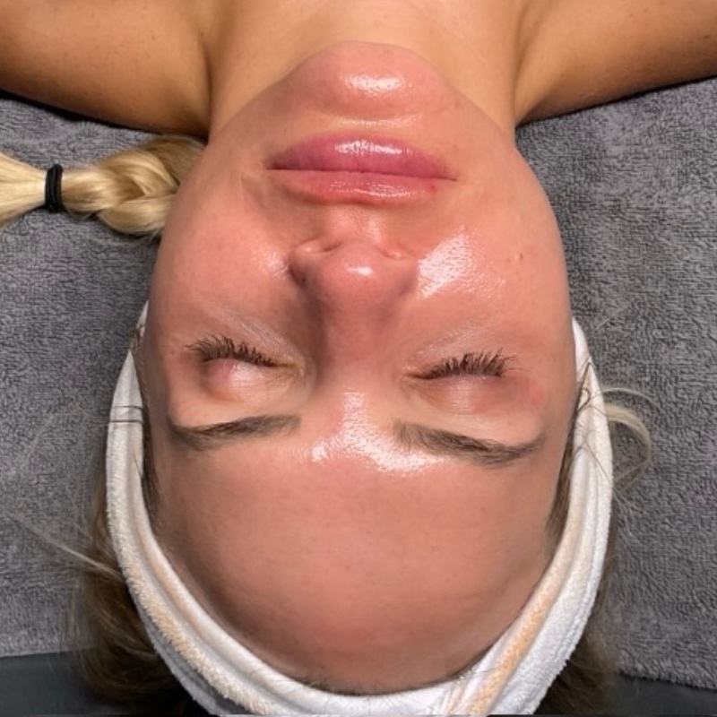 HydraFacials Before & After Image