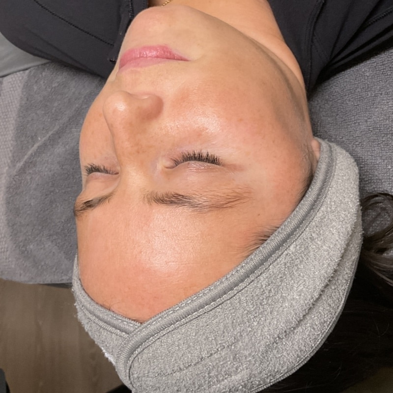 HydraFacials Before & After Image