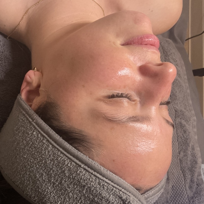 HydraFacials Before & After Image