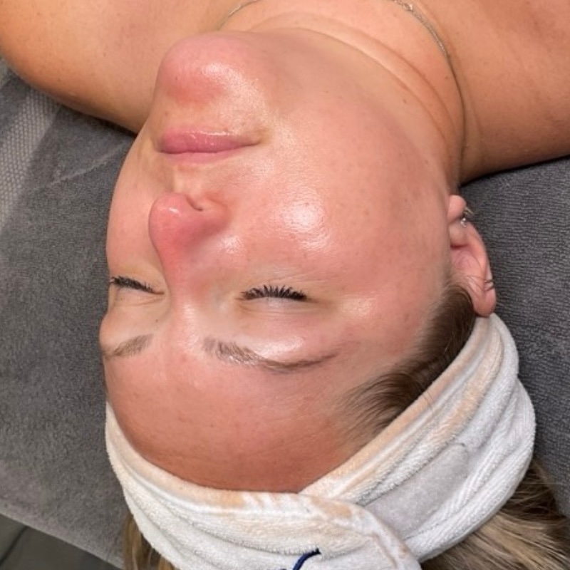 HydraFacials Before & After Image